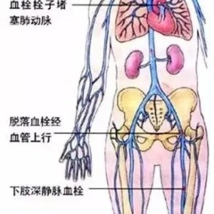 静脉血栓--藏匿在人体深处的隐患！
