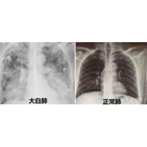 “大白肺”危及生命，国家认定的特效药清肺排毒汤去了哪里？