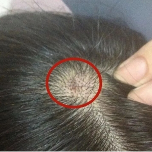 为什么头皮上总长红疙瘩和脓包？怎么回事？是什么引起的？不是小事，得当心