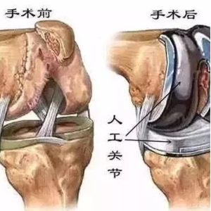 骨质增生骨刺，一味药可缓解！
